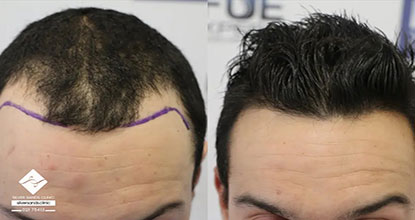 بهترین روش کاشت مو در سال ۱۴۰۴ کدام است