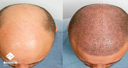 هزینه کاشت مو در سال ۱۴۰۴ چقدر است؟