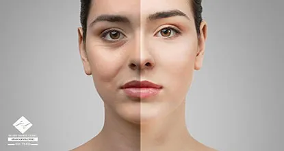 بلفاروپلاستی پلک پایین و بالا روش، مراحل و مراقبت‌های بعد از عمل